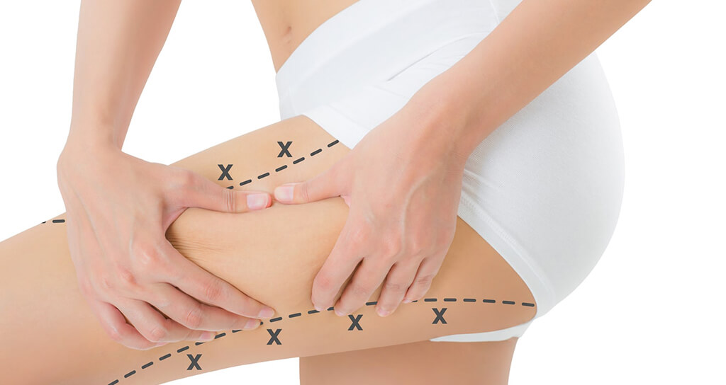 İstanbul Bacak Germe