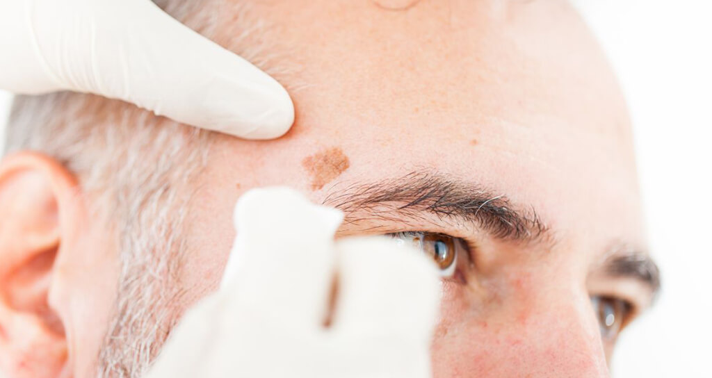 İstanbul Cilt Tümörleri ve Tedavisi