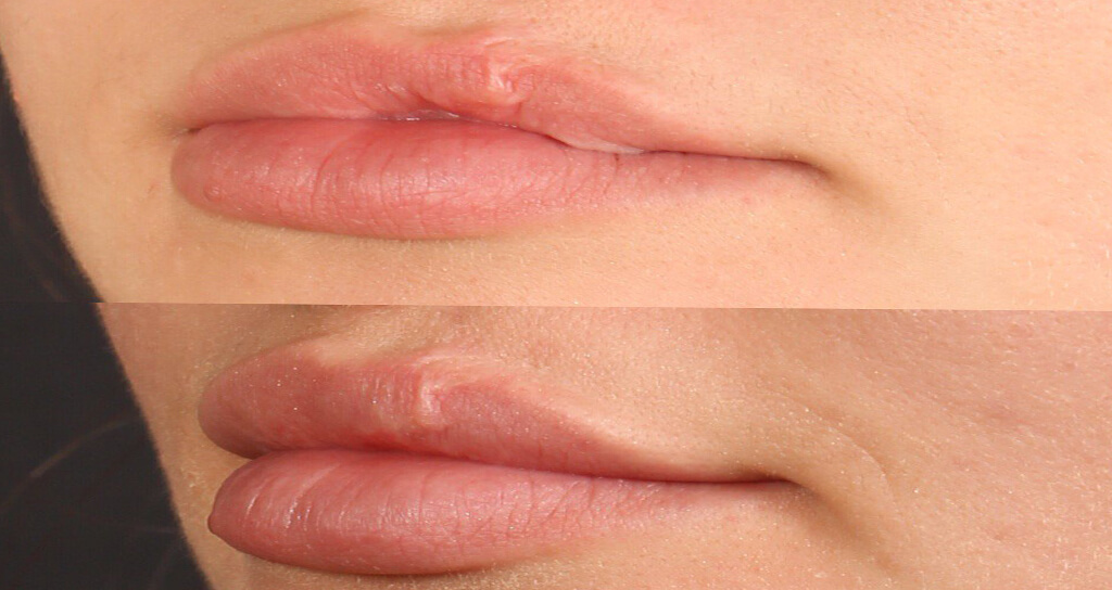 İstanbul Damak ve Dudak Yarığı Onarımı