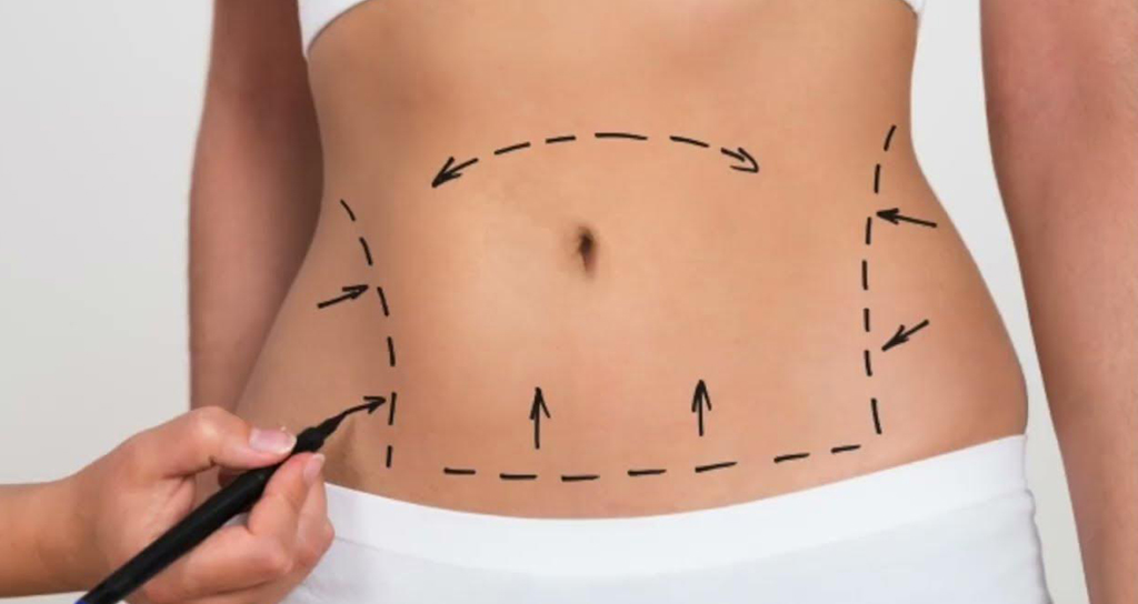 İstanbul Karın Germe Ameliyatı